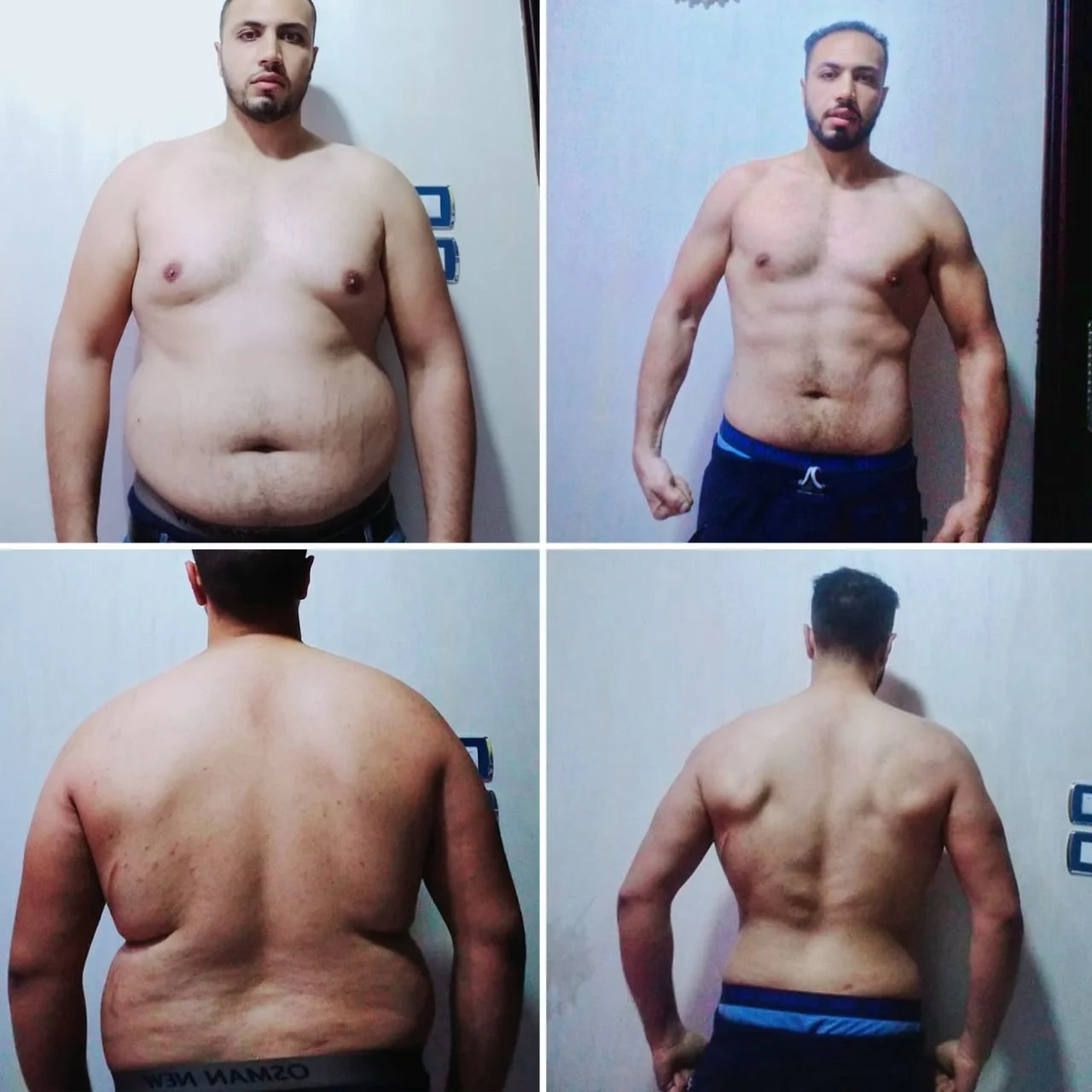 بديل التكميم
