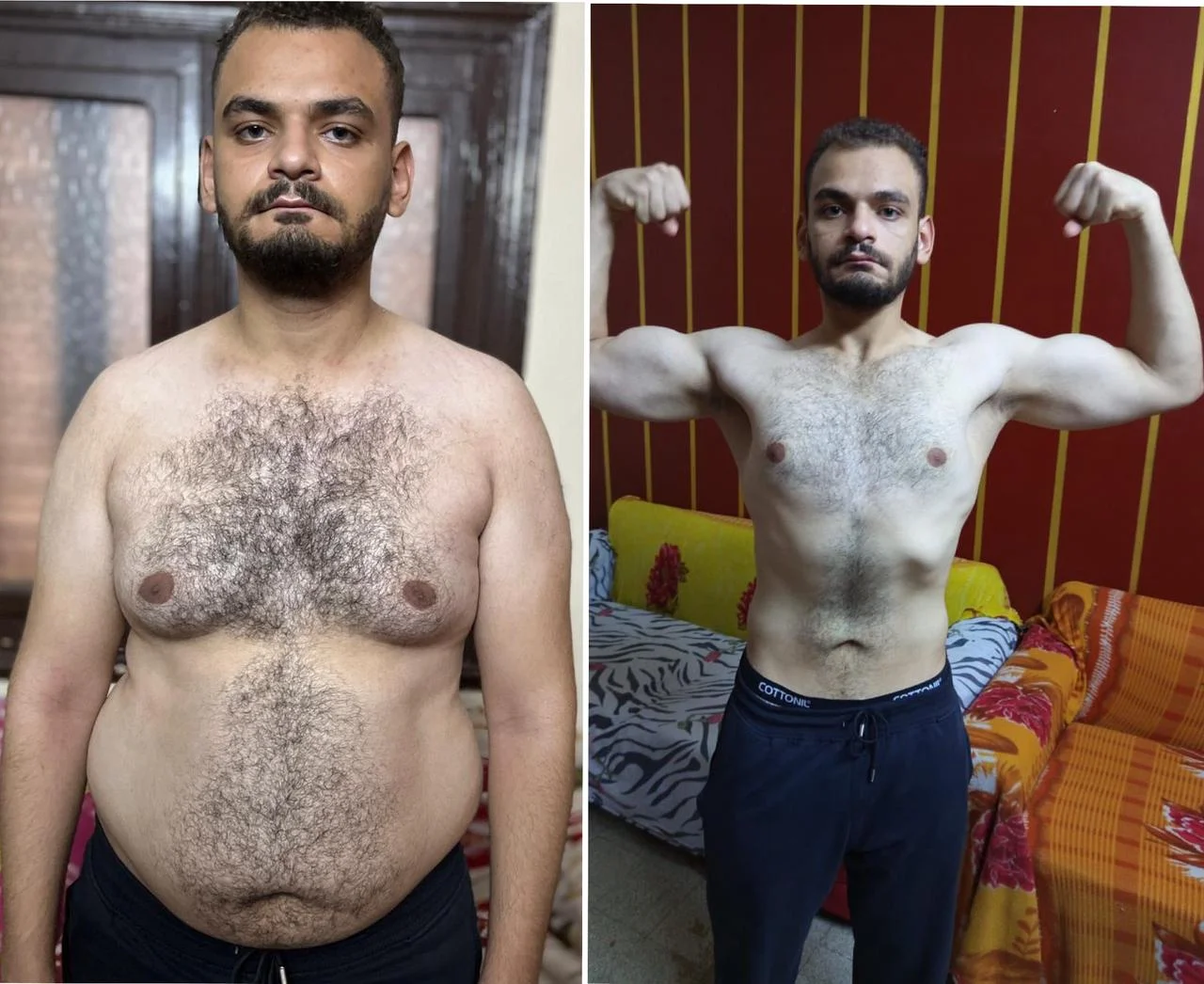 بديل التكميم
