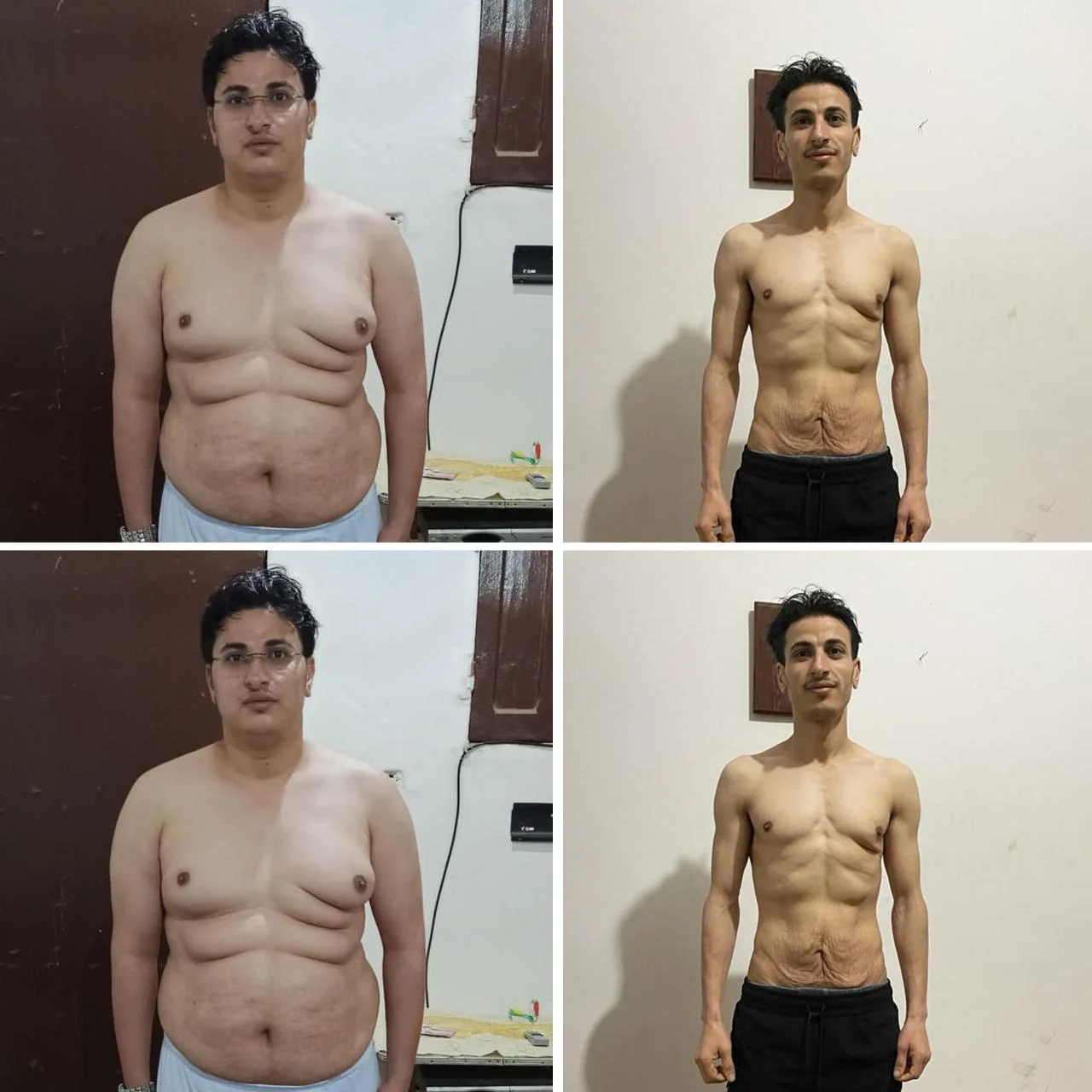 بديل التكميم