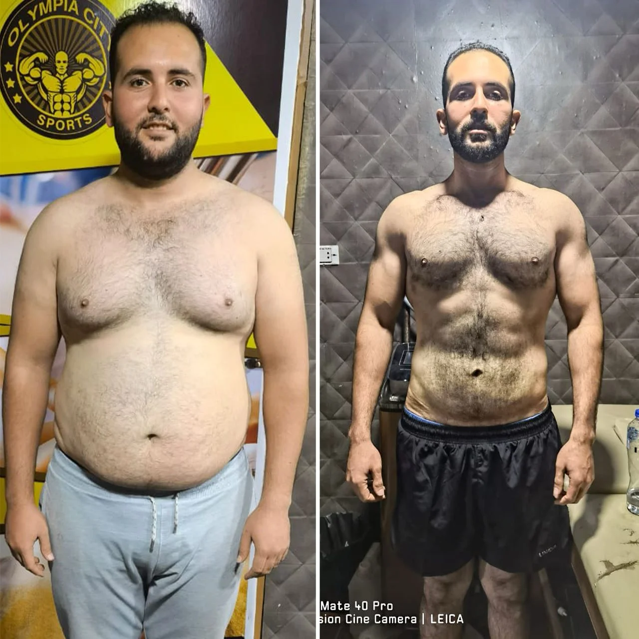 بديل التكميم