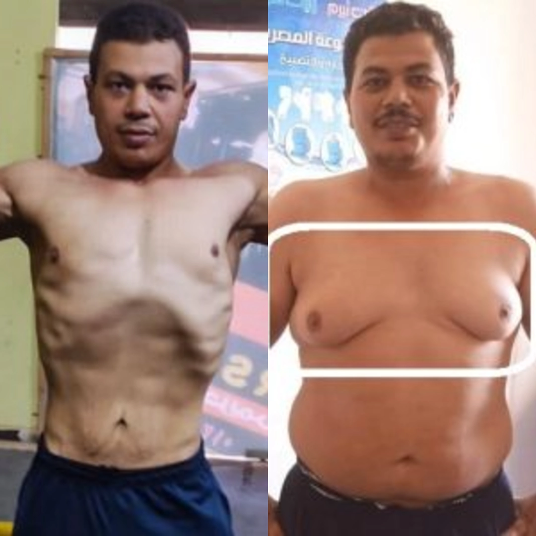 نتائج التثدي